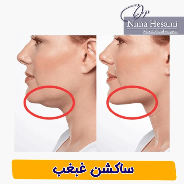 ساکشن غبغب: روش مؤثر برای رفع چربی اضافی زیر چانه