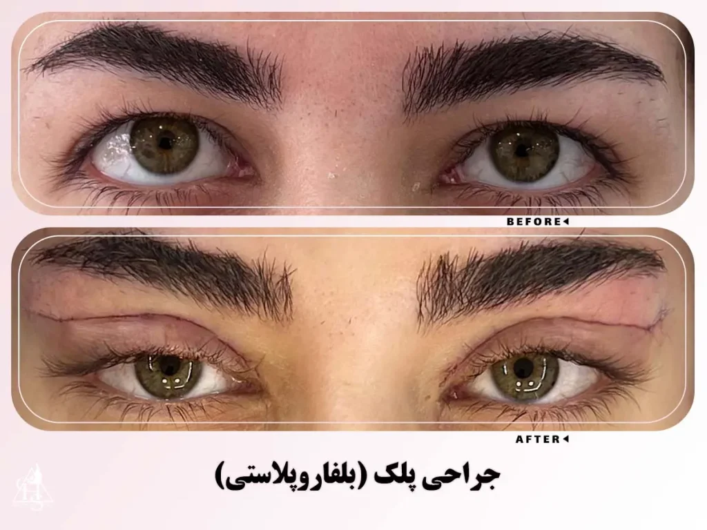 بلفاروپلاستی؛ جراحی زیبایی پلک بالا و پایین برای رفع افتادگی و پف چشم