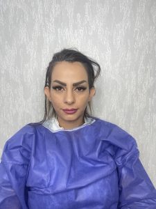 جراحی اتوپلاستی (جراحی زیبایی گوش ) - قبل از درمان